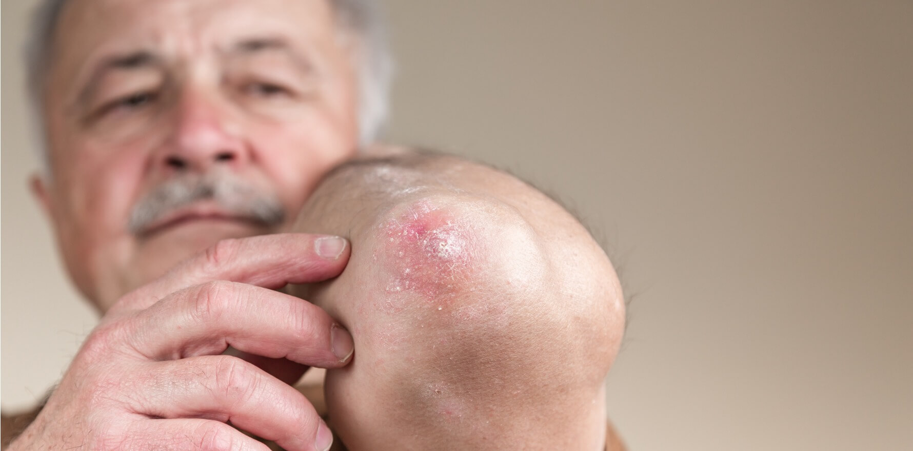 Skin Rash in the Elderly: Common Causes, Symptoms, and Care Tips
